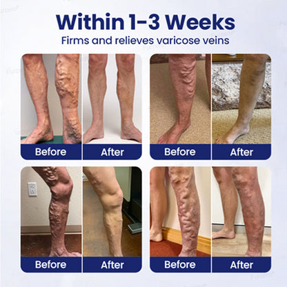 Varicose Veins Herbal Spray - MicroMist Therapy