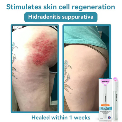 ✨All-in-One CO₂ Laser Eraser Pen | Removes Moles, Warts, Skin Flaws & Pigmentation