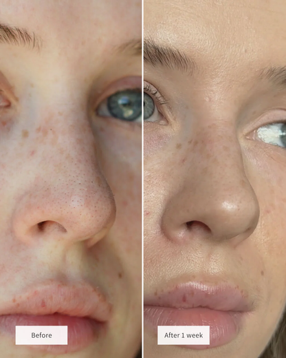 Deep Cleaning Blackhead Remover Nose Patches